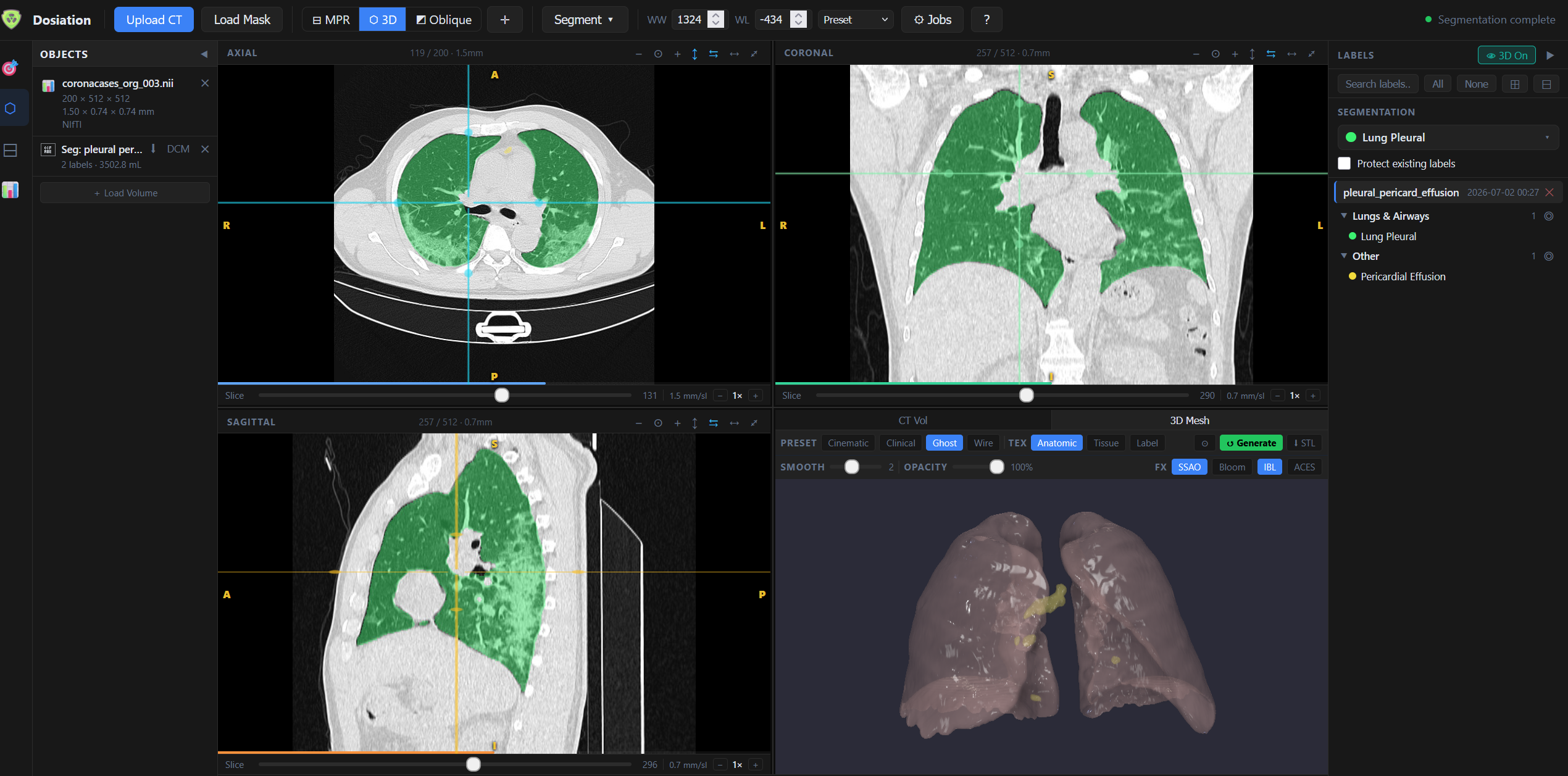 4-panel MPR workspace with lung pleural segmentation complete